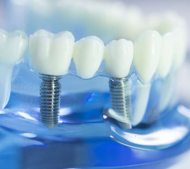 Point Pleasant Dental Implants