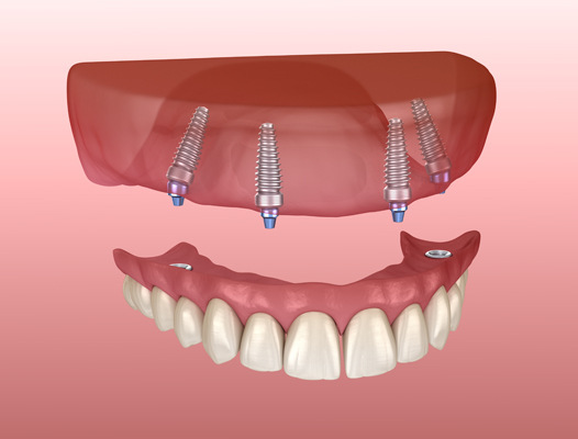 Advantages And Drawbacks Of Implant Supported Dentures