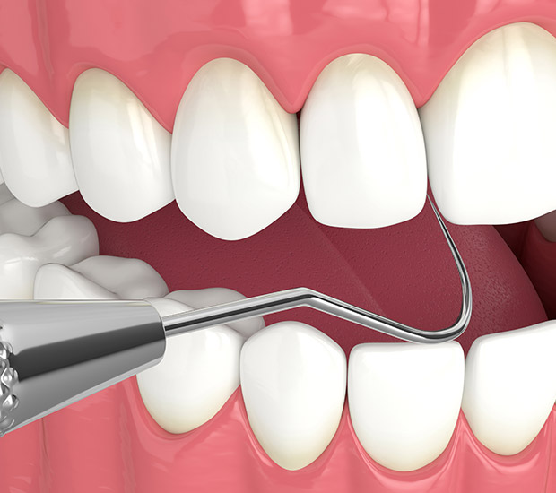 Point Pleasant Interactive Periodontal Probing